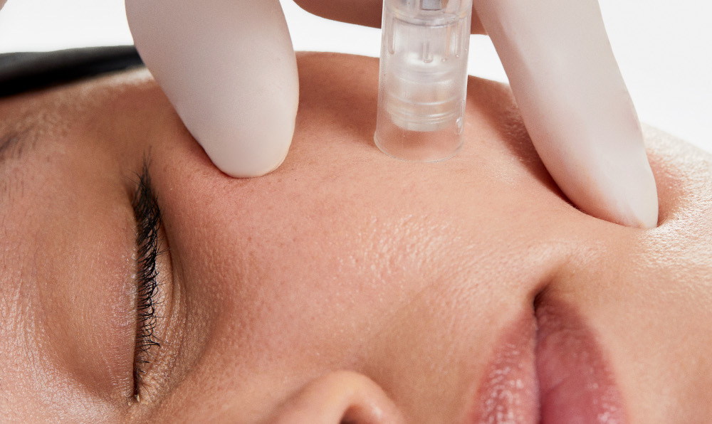 Microneedling